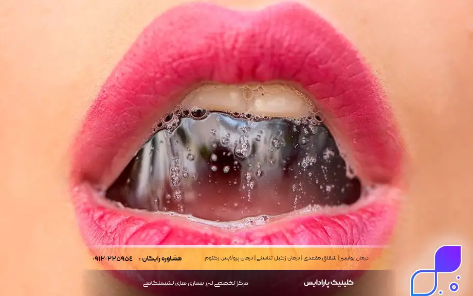 انتقال HPV از طریق بزاق