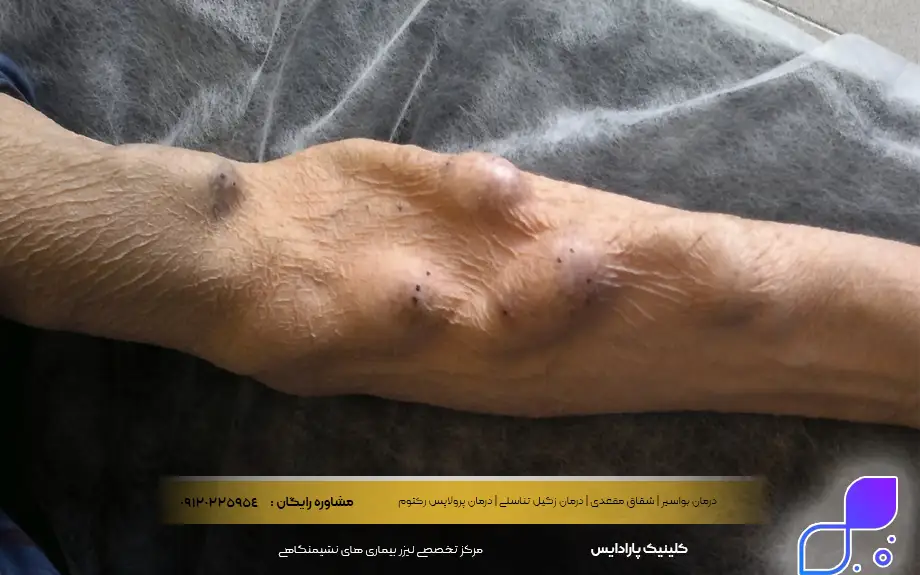 عوارض فیستول دست