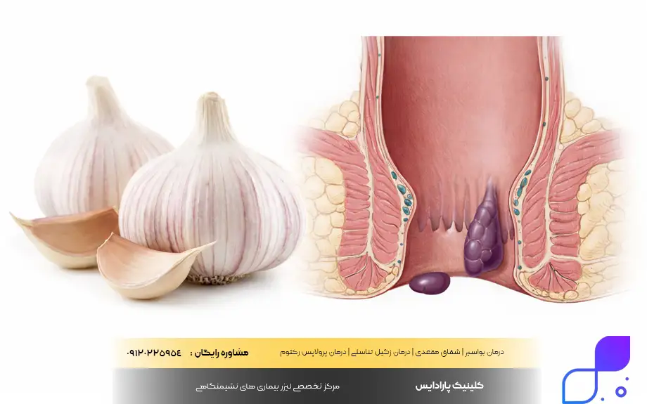 درمان بواسیر با سیر