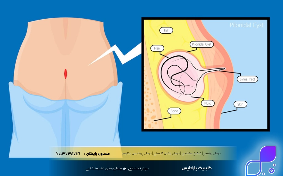 عمل سرپایی کیست مویی با لیزر