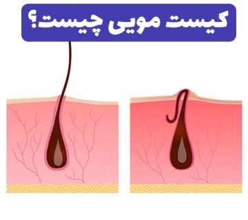کیست مویی چیست؟