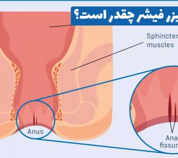 هزینه لیزر فیشر
