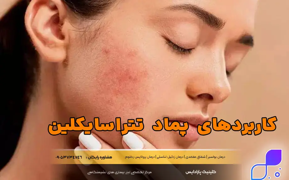 کاربردهای پماد تتراسایکلین