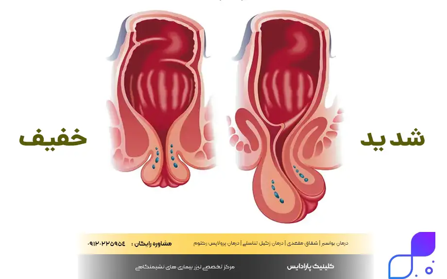 بیرون زدگی مقعدی بدون درد و خونریزی