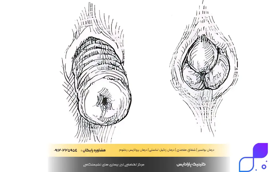 پرولاپس رکتوم چیست