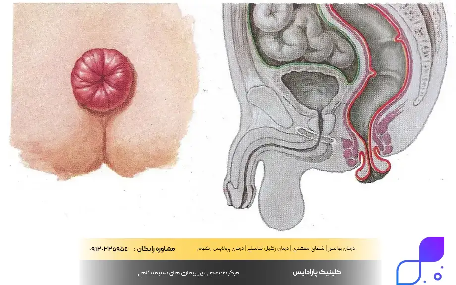 عکس بیرون زدگی روده