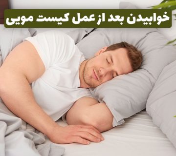 خوابیدن بعد از عمل کیست مویی