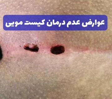 عوارض عدم درمان کیست مویی