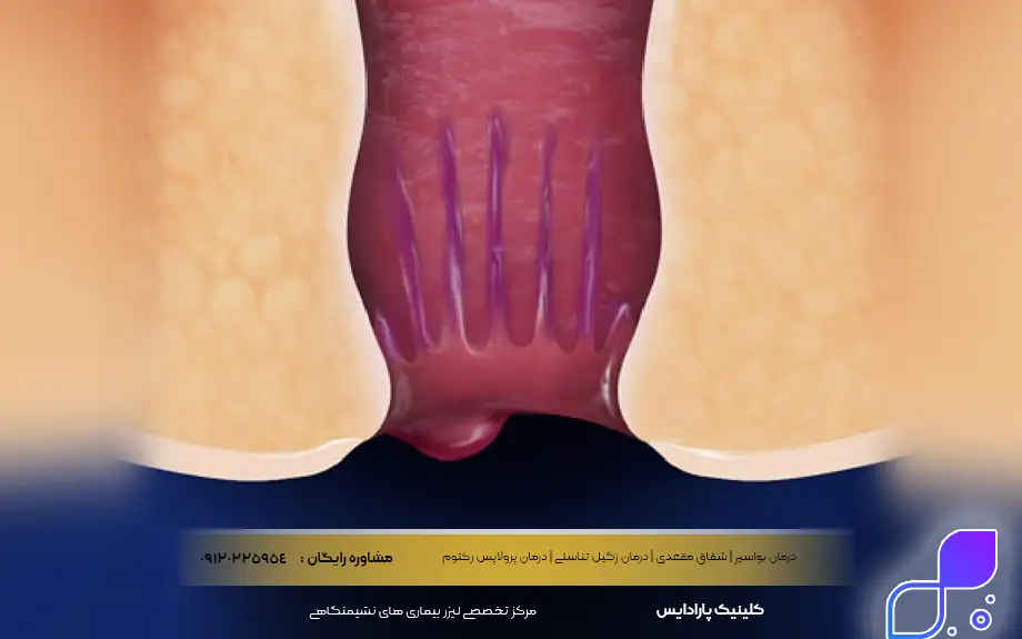 بواسیر دکمه ای چیست