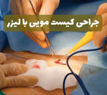 جراحی کیست مویی با لیزر