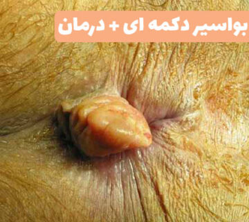 عکس بواسیر دکمه ای