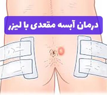 درمان آبسه مقعدی با لیزر