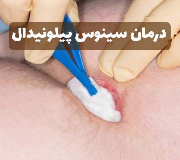 درمان سینوس پیلونیدال