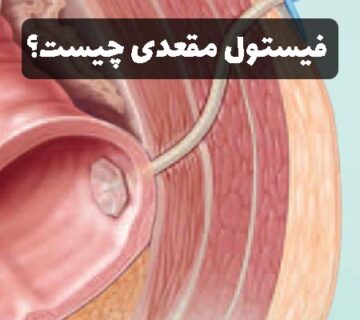 فیستوی مقعدی چیست؟