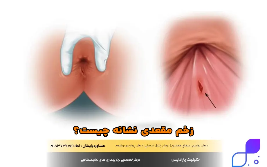 زخم مقعدی نشانه چیست؟