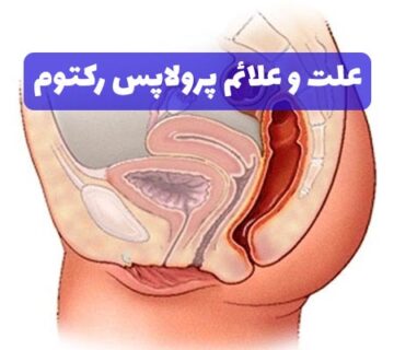 علت و علائم پرولاپس رکتوم