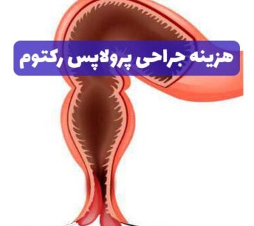 هزینه جراحی پرولاپس رکتوم