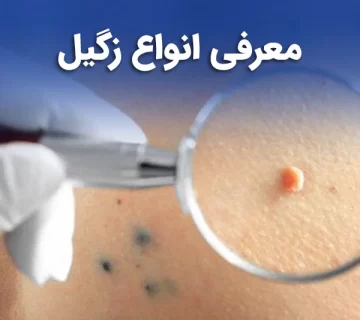 معرفی انواع زگیل تناسلی و پوستی
