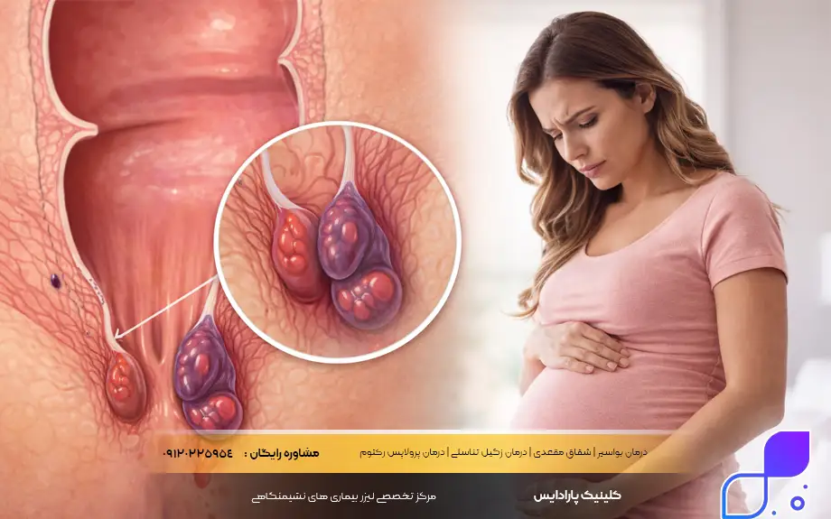 عکس بواسیر در بارداری