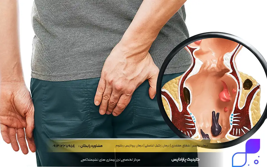 عکس بواسیر در مردان