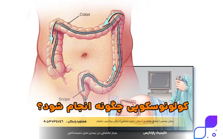 کولونوسکوپی چگونه انجام شود؟