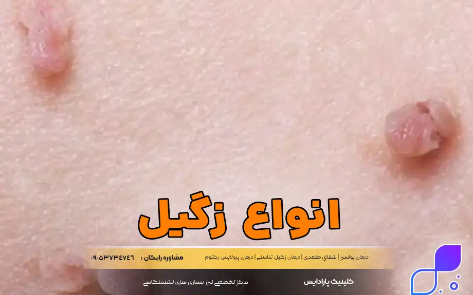 انواع زگیل مقعدی