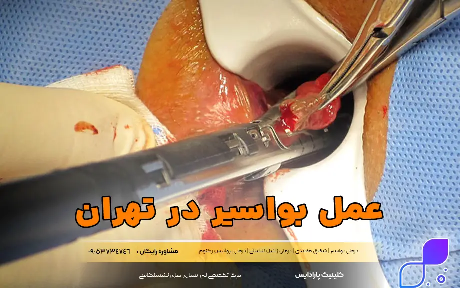عمل بواسیر در تهران