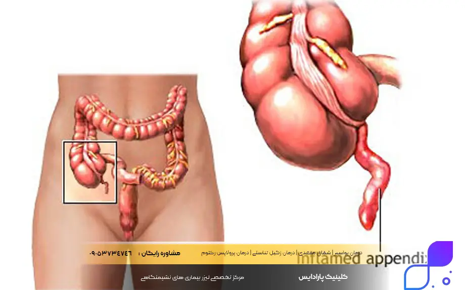 چه زمانی انسداد روده نیاز به جراحی دارد