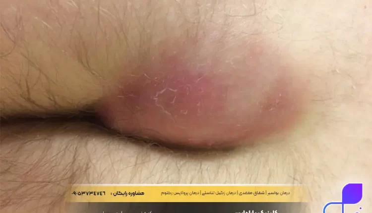 درمان کیست مویی | بدونه درد و خونریزی و نقاهت درمان کیست مویی
