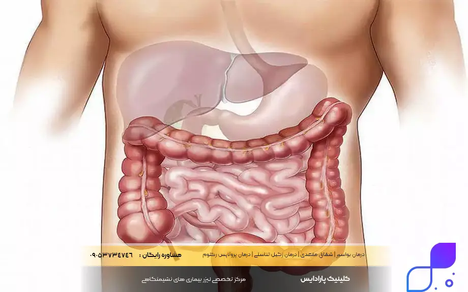 آیا انسداد روده سرطان است؟