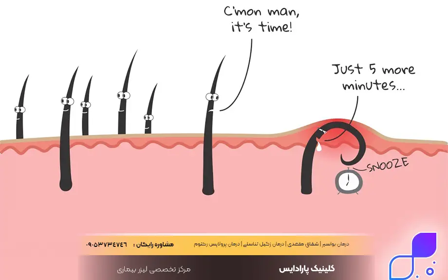 انواع کیست مویی