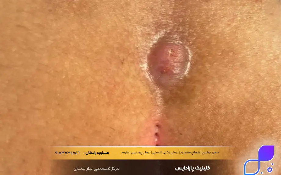 عکس کیست مویی