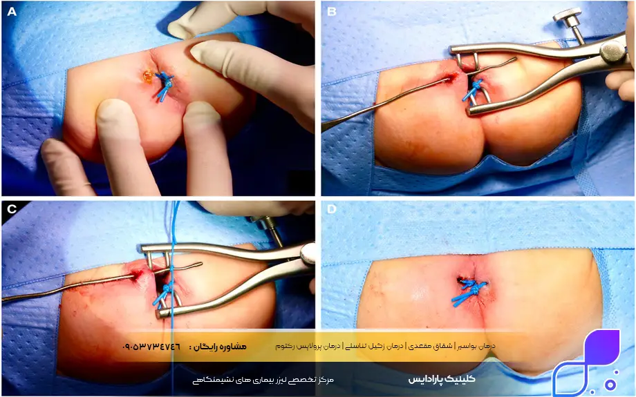 عمل فیستول با لیزر بهتر است یا جراحی