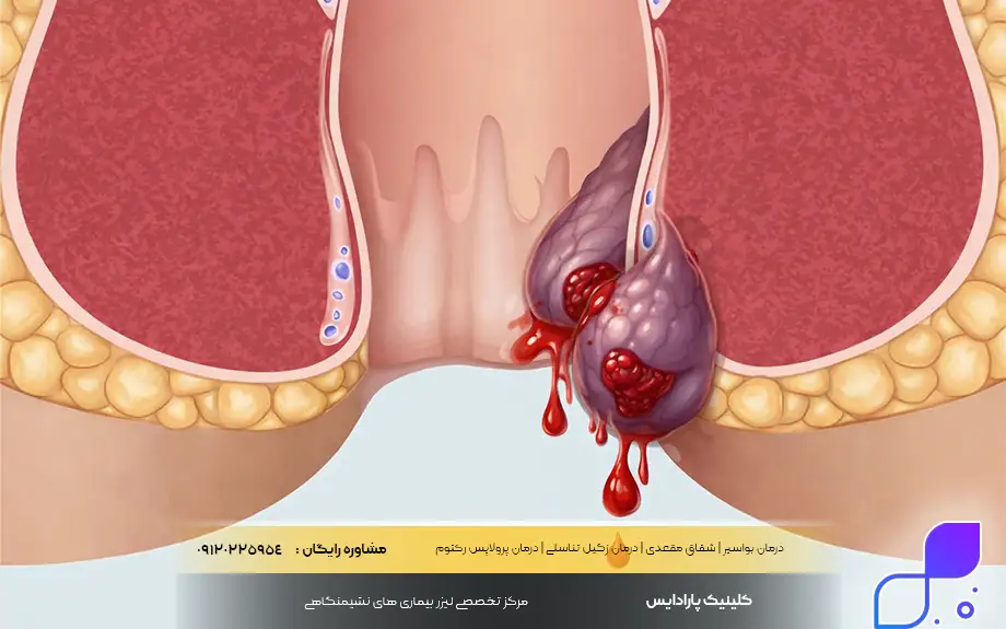 بواسیر خونی چیست