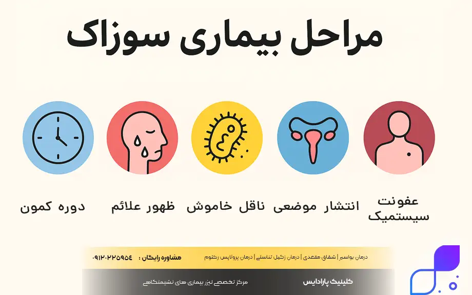 مراحل بیماری سوزاک