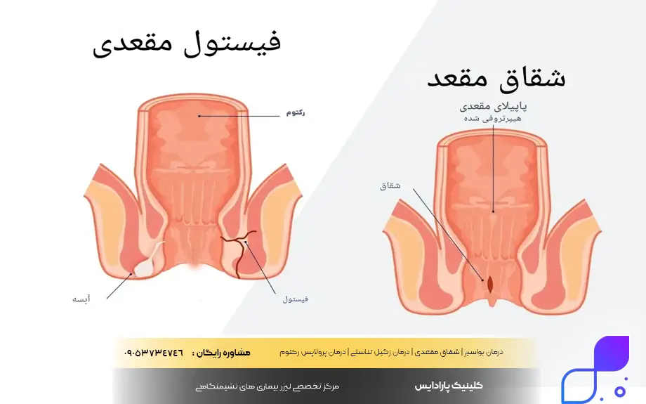 شقاق مقعدی و فیستول مقعدی