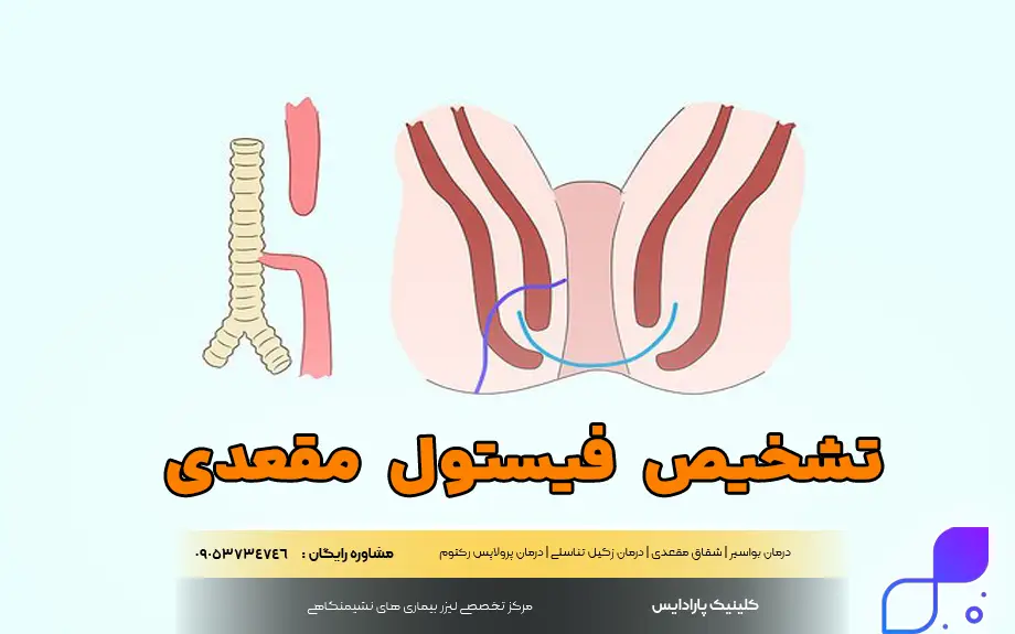 تشخیص فیستول مقعدی