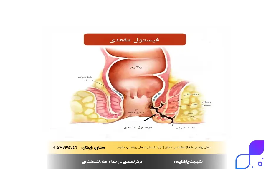 بررسی انواع فیستول مقعدی