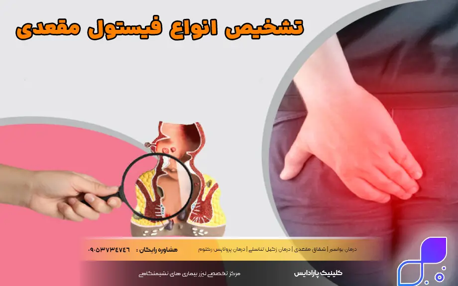 تشخیص انواع فیستول مقعدی