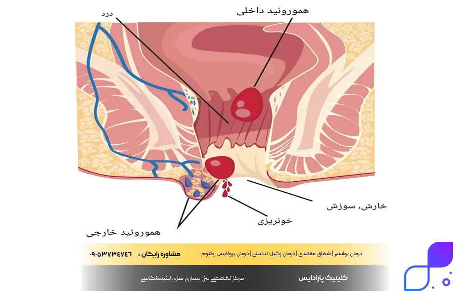 عکس هموروئید داخلی