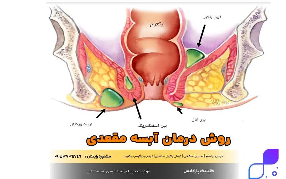 روش درمان آبسه مقعدی
