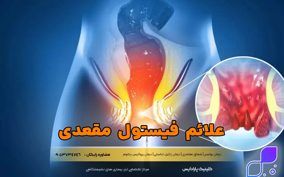 علائم فیستول مقعدی