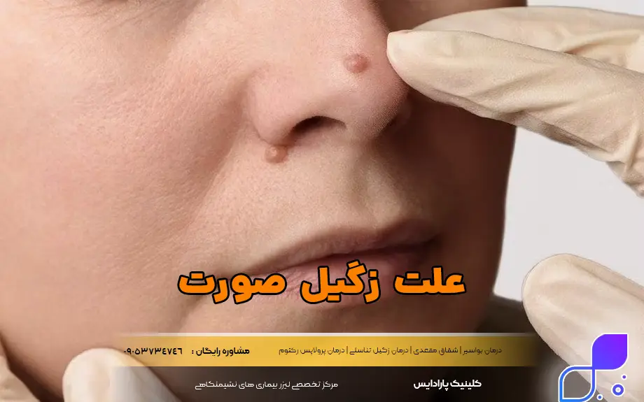 علت زگیل صورت