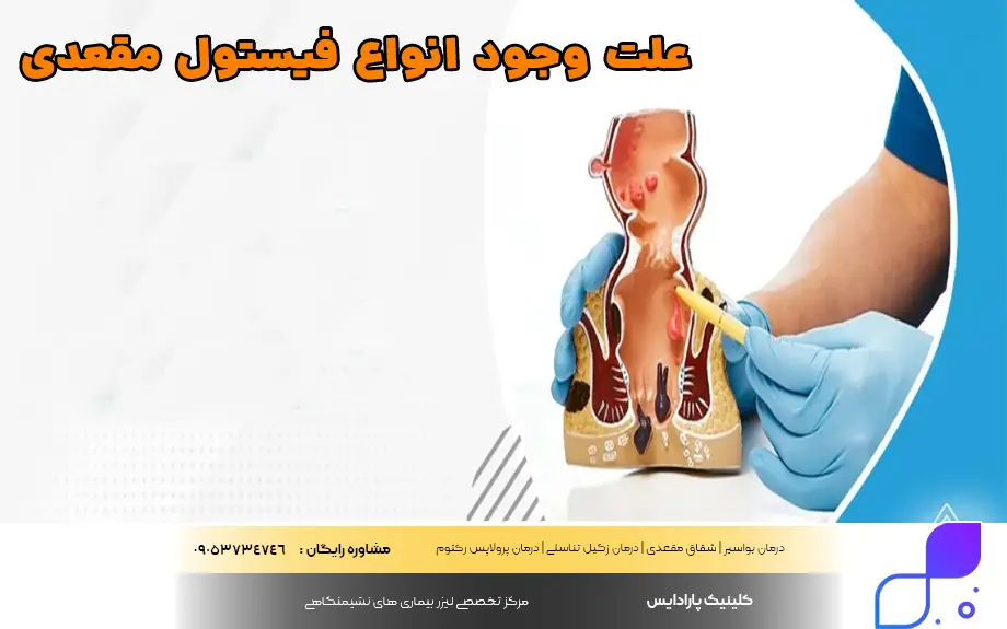 علت وجود انواع فیستول مقعدی