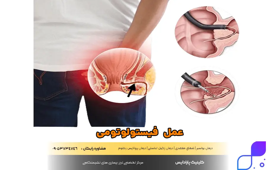 عمل استن یا ستون