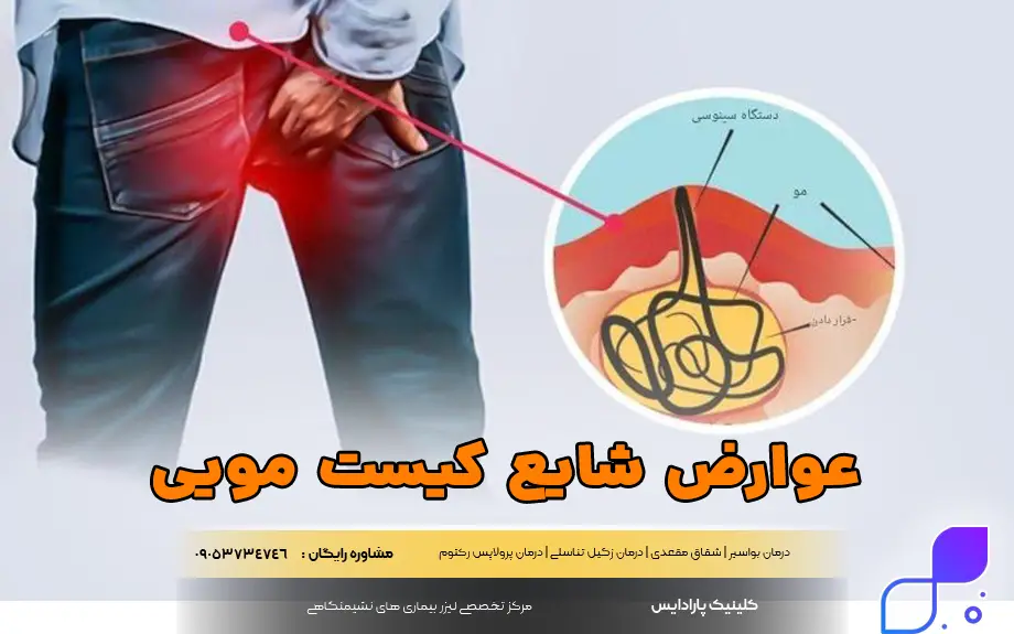 عوارض شایع کیست مویی