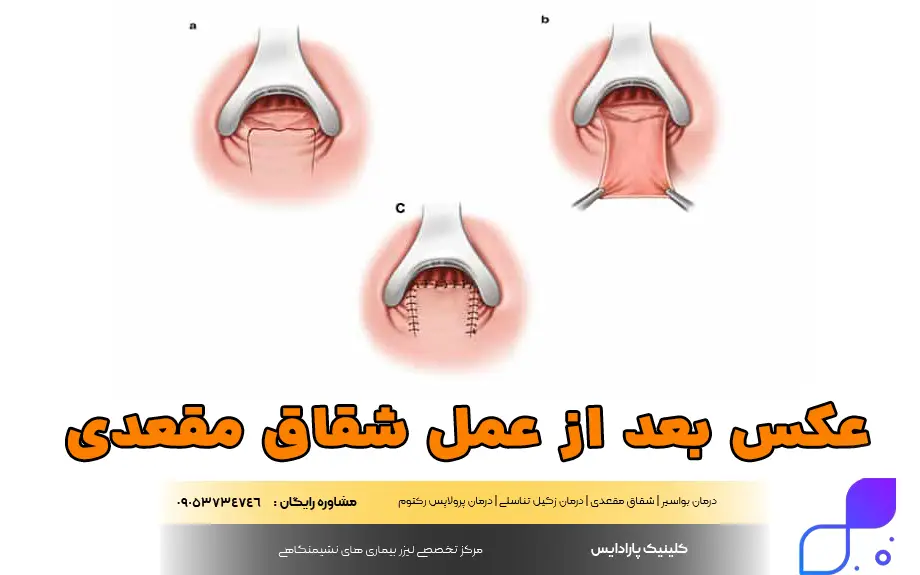 عکس بعد از عمل شقاق مقعدی