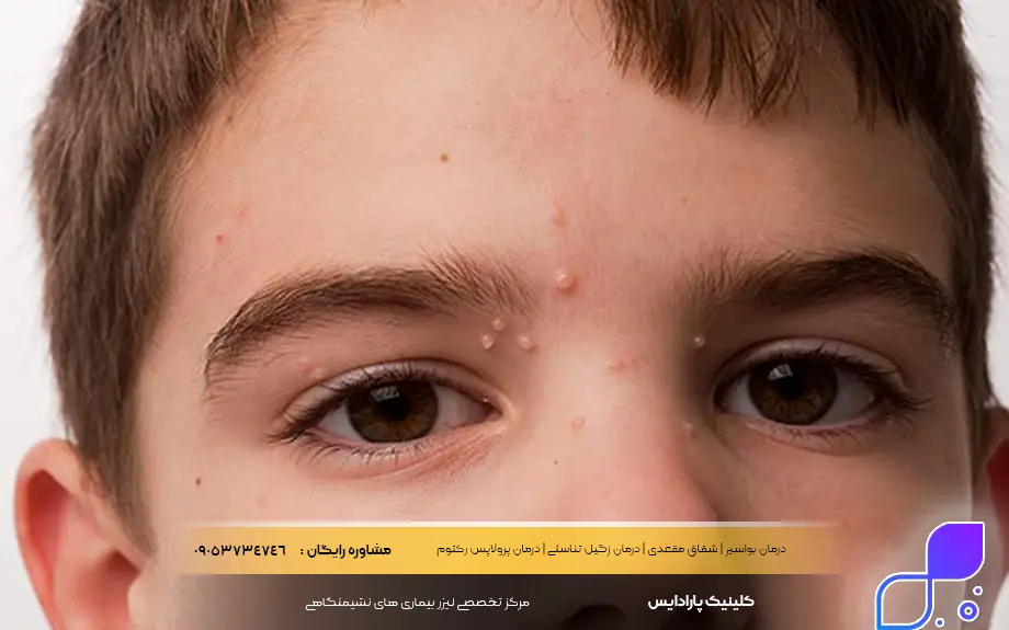 عکس زگیل صورت در کودکان