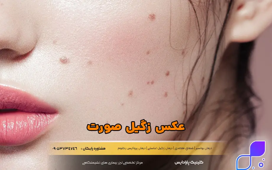 عکس زگیل صورت