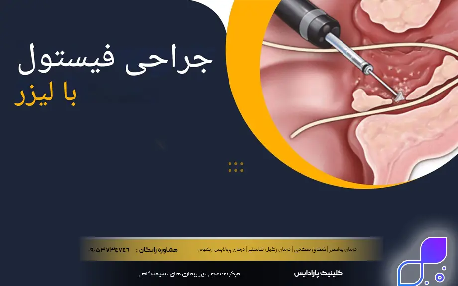 لیزر فیستول مقعدی